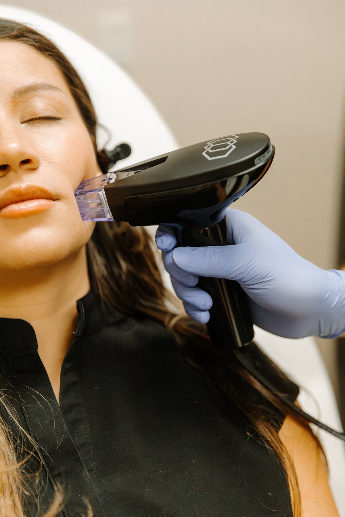 Morpheus8 radiofrequency microneedling treatment at Serene Med Spa